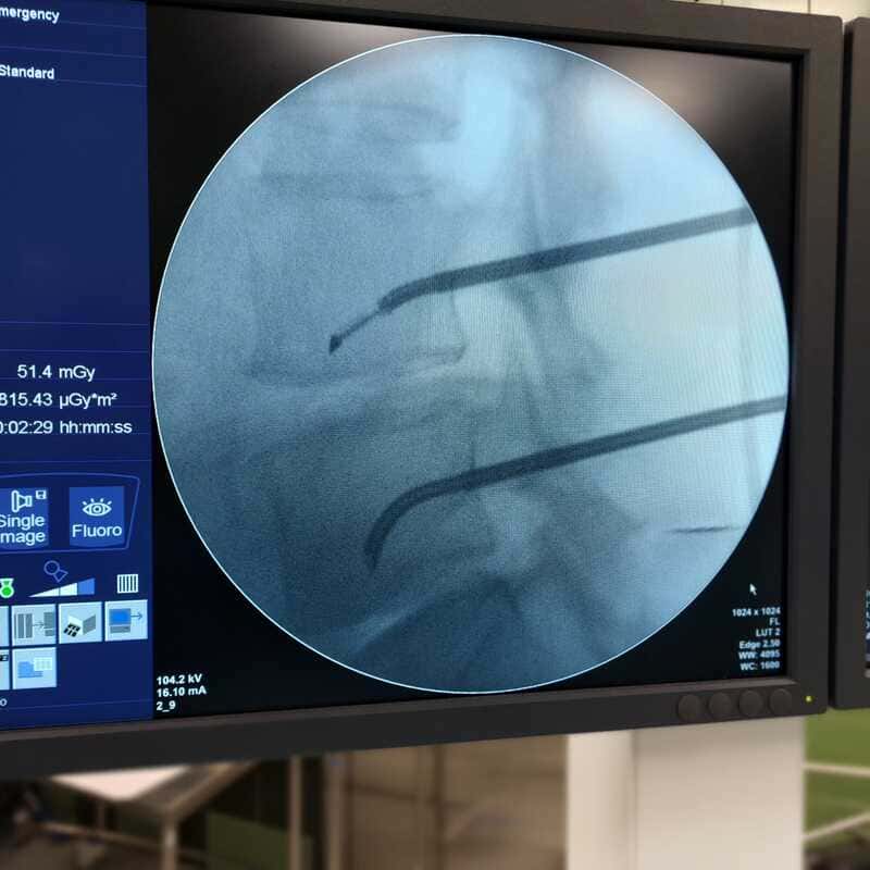 Ablación con radiofrecuencia de nervio basivertebral