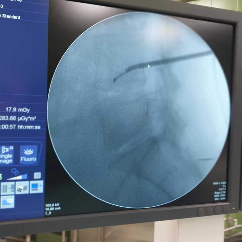 Ablación con radiofrecuencia de nervio basivertebral