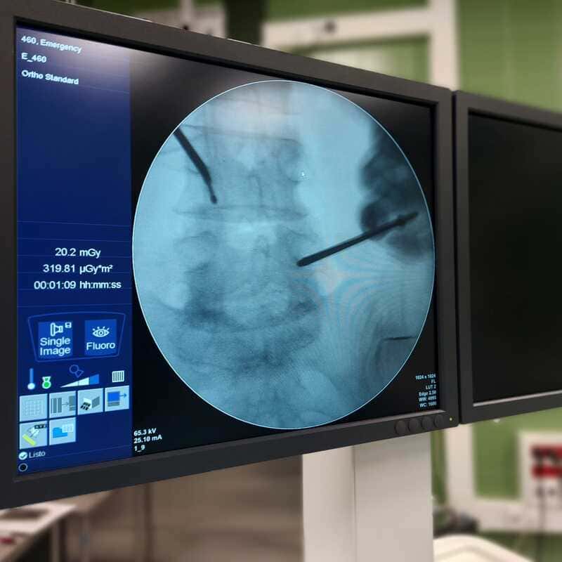 Ablación con radiofrecuencia de nervio basivertebral