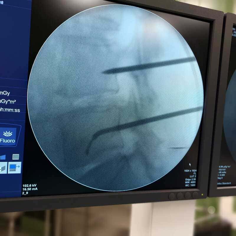 Ablación con radiofrecuencia de nervio basivertebral