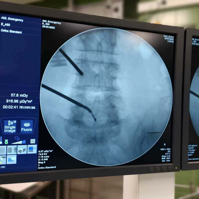 Ablación con radiofrecuencia de nervio basivertebral