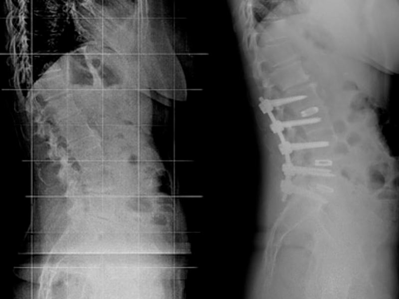 Escoliosis en Adultos Desviación de columna adultos