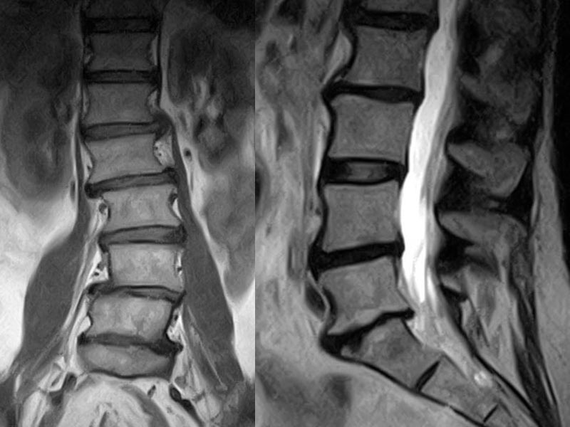 Escoliosis en Adultos Desviación de columna adultos