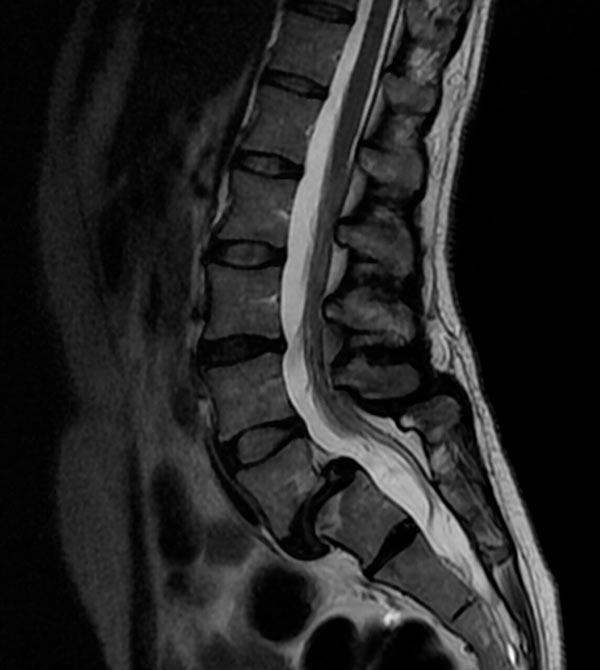 Espindilolistesis, desplazamiento de una vértebra