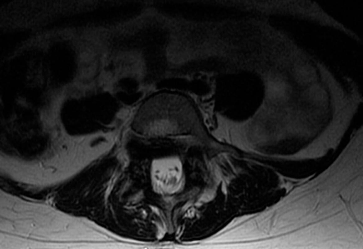 Espindilolistesis, desplazamiento de una vértebra