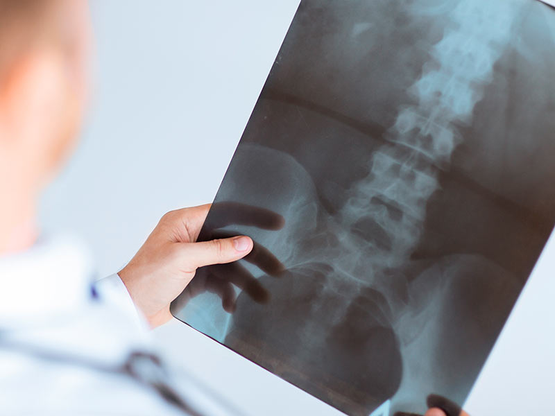 Dr José Quintana Cruz Traumatismos de columna vertebral